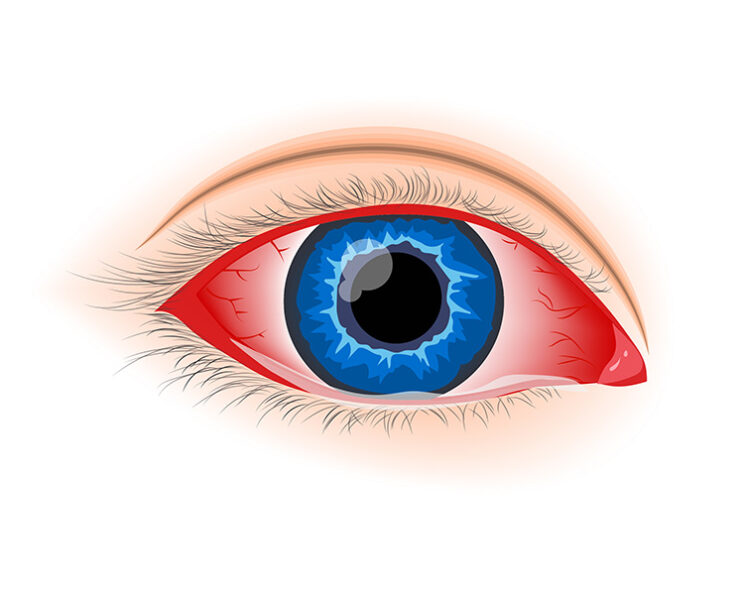 Close-up view of an eye affected by viral conjunctivitis, showing redness and watery eyes.